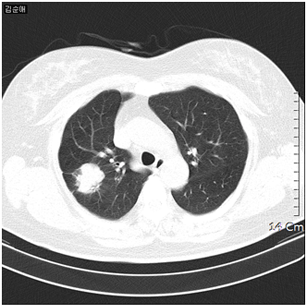 폐암 환자의 흉부 CT